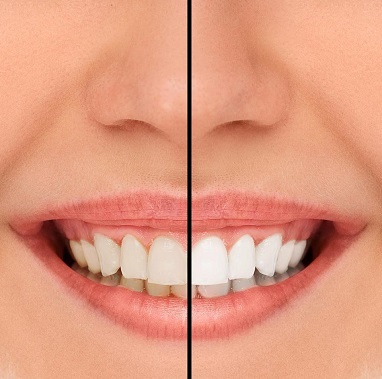 Laser gum whitening before and after