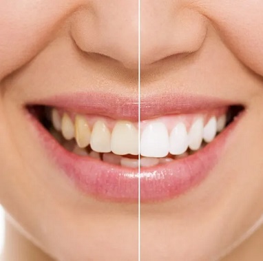 Laser gum whitening before and after