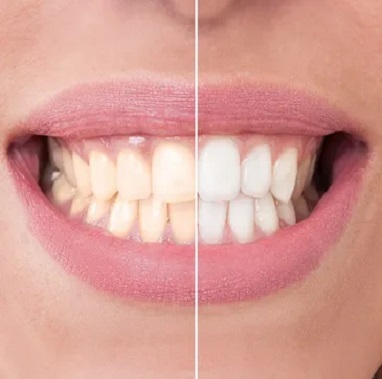 Laser gum whitening before and after