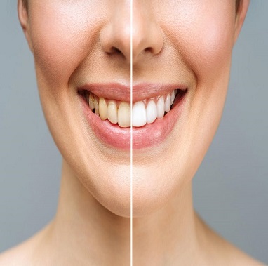 Laser gum whitening before and after