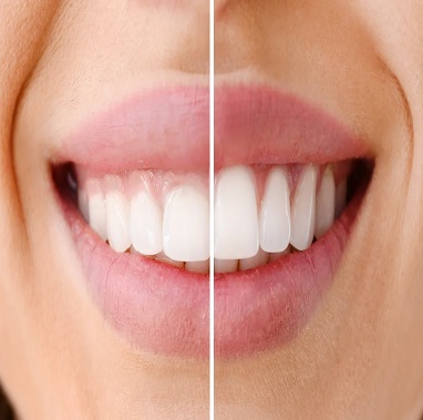 Laser gum whitening before and after