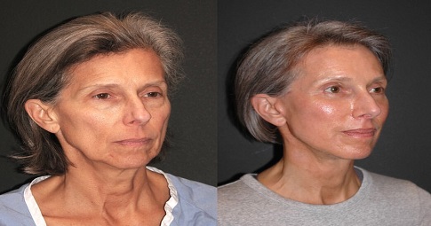 8-Point Facelift before and after