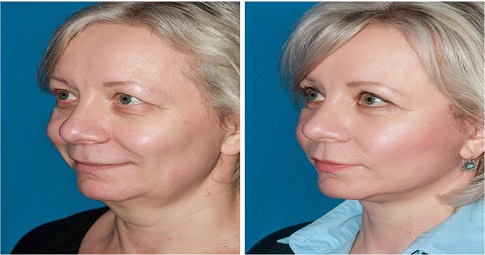 8-Point Facelift before and after