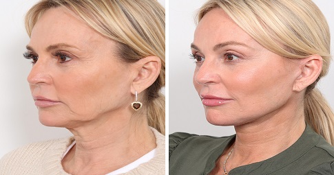 8-Point Facelift before and after