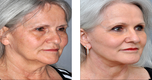 8-Point Facelift before and after
