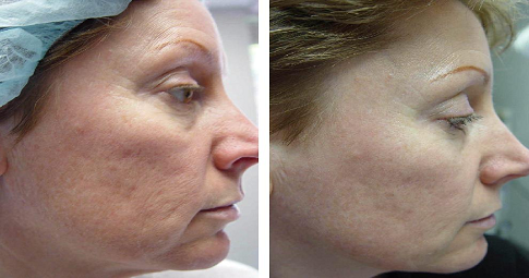 Pico Laser Treatment before and after