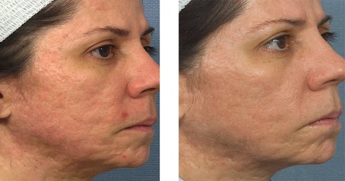 Pico Laser Treatment before and after