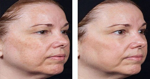Pico Laser Treatment before and after