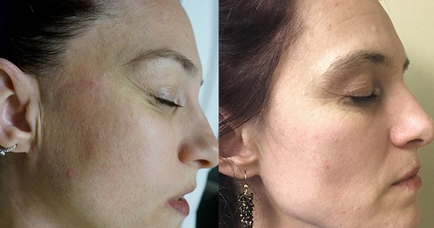 Pico Laser Treatment before and after