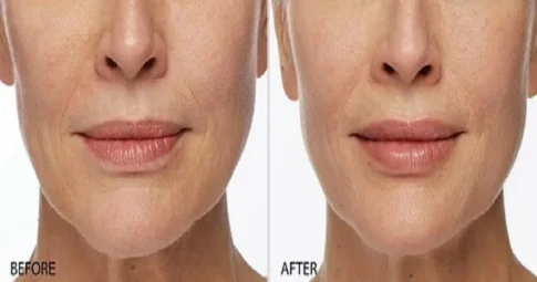 Sculptra Fillers before and after
