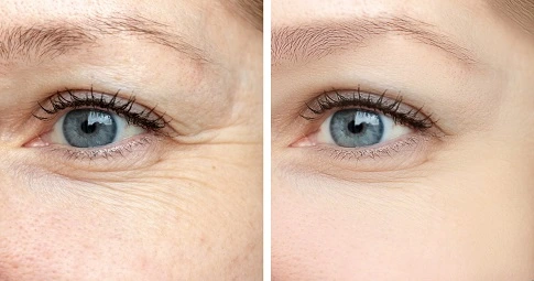 Sculptra Fillers before and after