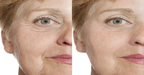 Sculptra Fillers before and after