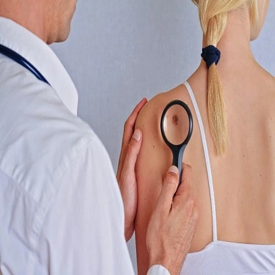 Skin tag removal in Dubai