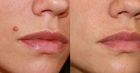 Skin tag removal before and after