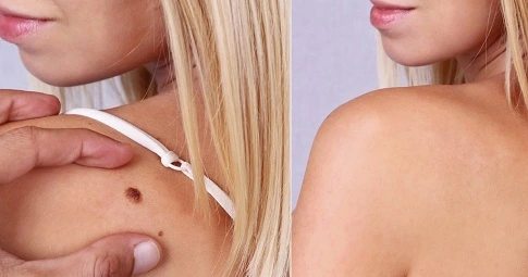 Skin tag removal before and after