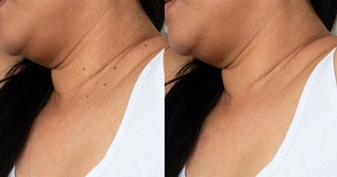 Skin tag removal before and after