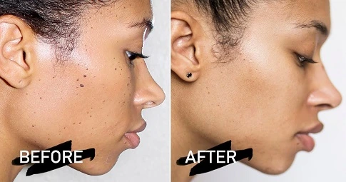 Skin tag removal before and after