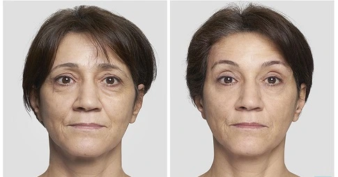 Thread Lift in Dubai before and after