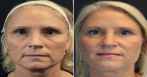 Thread Lift in Dubai before and after