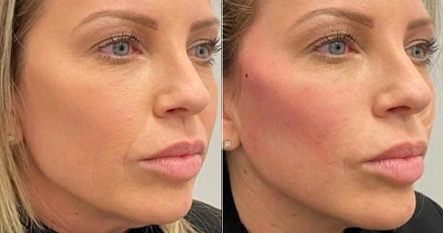 Thread Lift in Dubai before and after