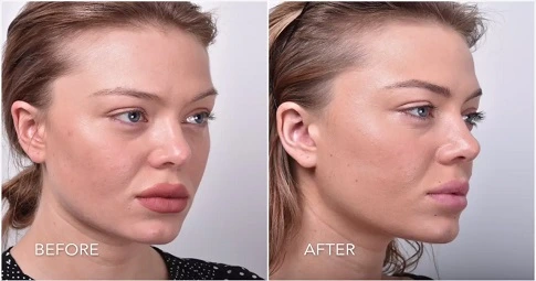 Thread Lift in Dubai before and after