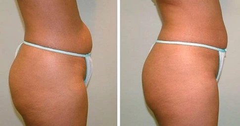 Velashape 3 Treatment before and after