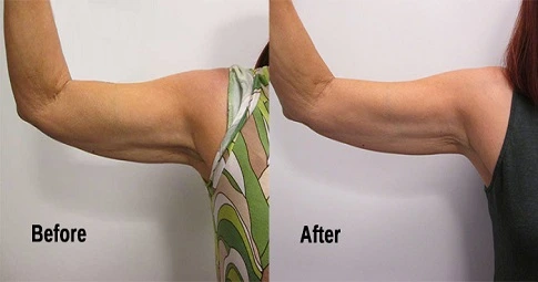 Velashape 3 Treatment before and after