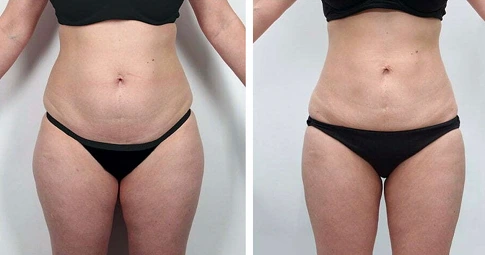 Velashape 3 Treatment before and after