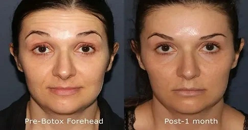 Xeomin Treatment in Dubai