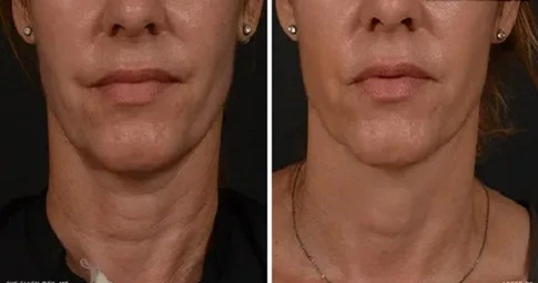 Xeomin Treatment in Dubai