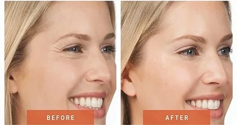 Xeomin Treatment in Dubai