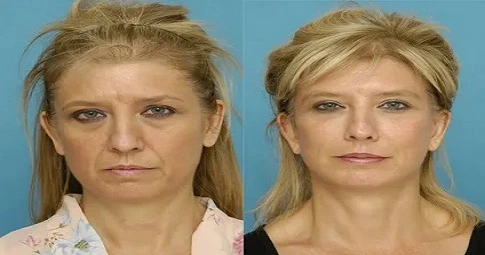 Xeomin Treatment in Dubai