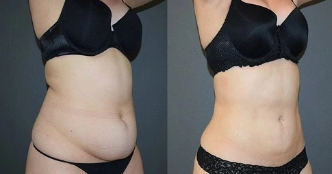 4D Vaser Liposuction before and after