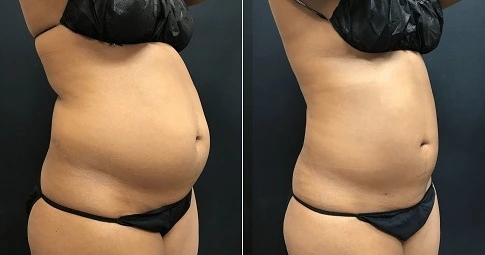 4D Vaser Liposuction before and after