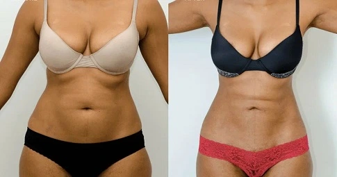 4D Vaser Liposuction before and after