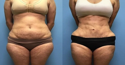 4D Vaser Liposuction before and afer