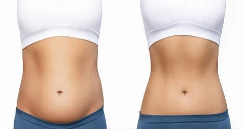 Body Sculpting before and after