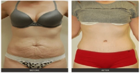 Circumferential Abdominoplasty in Dubai