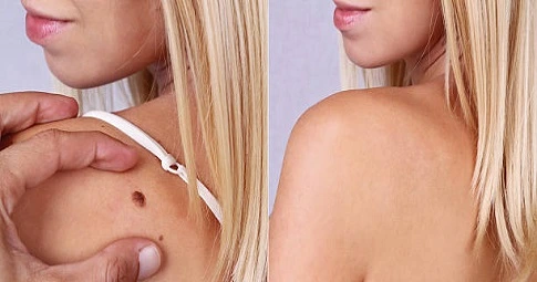 Lipoma Treatment before and after