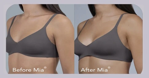Breast Augmentation before and after