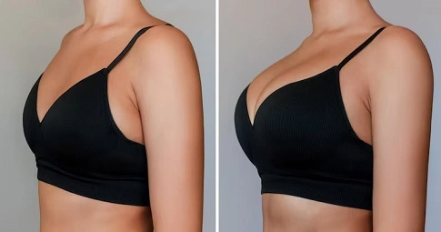 Breast Implants before and after