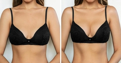 Breast Implants before and after