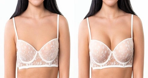 Breast Implants before and after