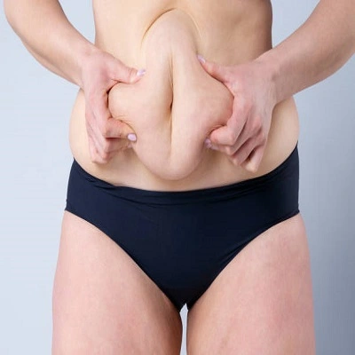 Circumferential Tummy Tuck in Dubai