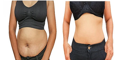 Circumferential Tummy Tuck before and after