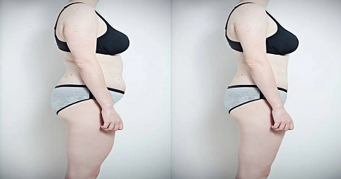 Circumferential Tummy Tuck before and after