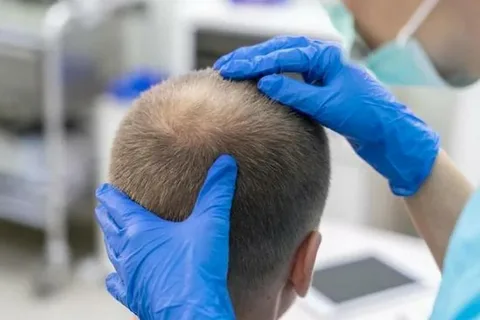 Exosome Hair Therapy in Dubai