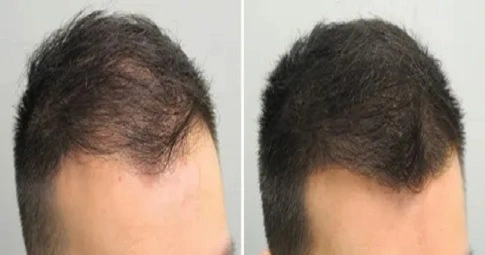 Exosome Hair Therapy before and after