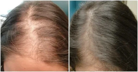 Exosome Hair Therapy before and after