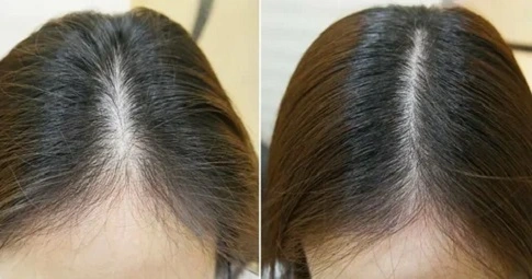 Exosome Hair Therapy before and after
